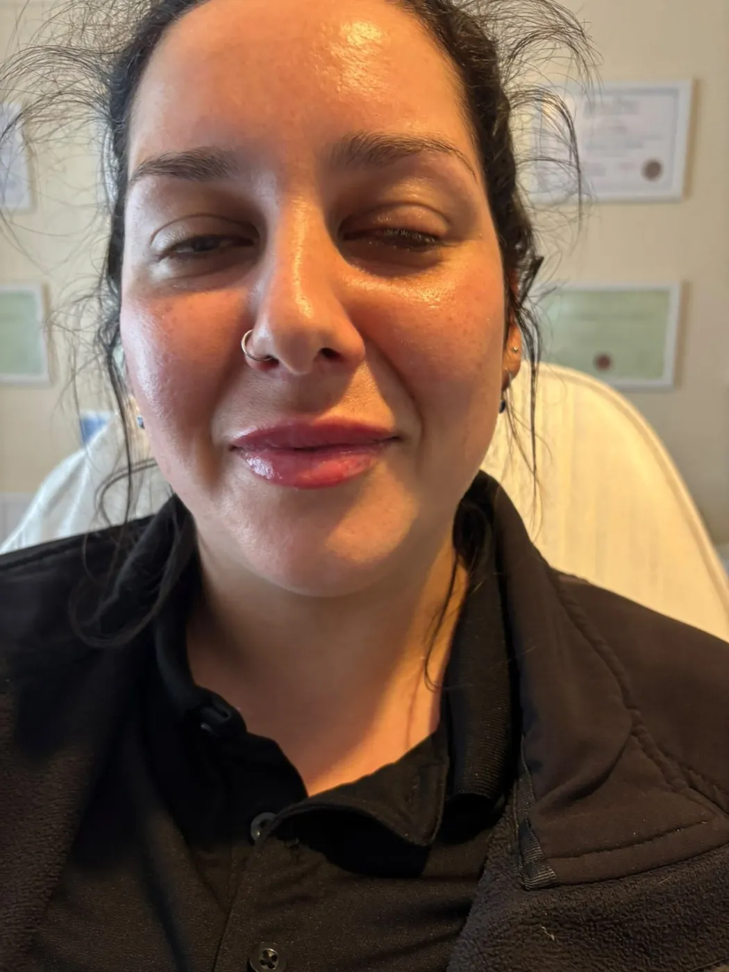 Pdo Threads For Lips Aesthetics Clinic in Oakham | Pre-emptive Aesthetics
